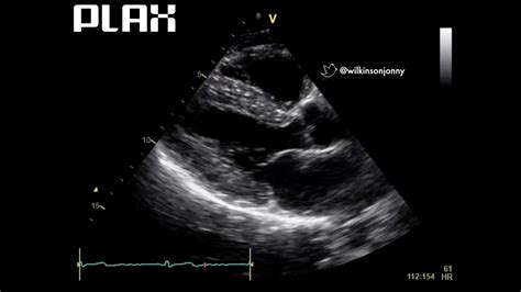 Parasternal Long Axis View Plax Youtube