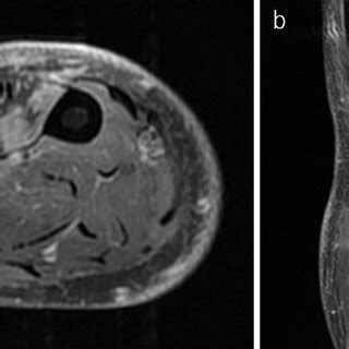 Figure2 Contrast Magnetic Resonance Imaging Findings A A