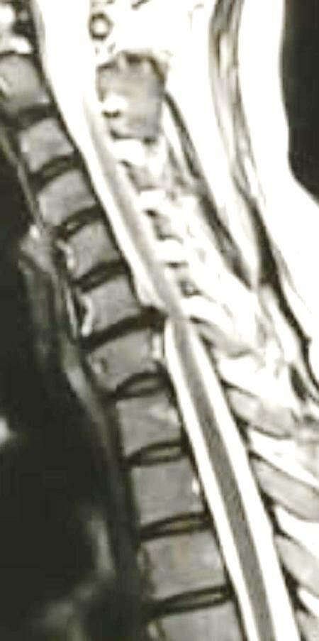 Figer 1 Pre Oprative Sagittal Mri Cervical Spine Show C 6 7 Disc