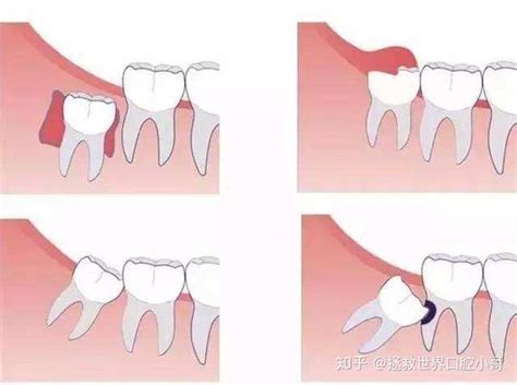 哪些情况需要拔除智齿？ 知乎