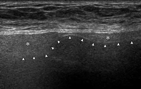 Multimodality Imaging Based Evaluation Of Single Lumen Silicone Breast Implants For Rupture