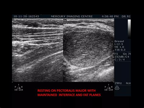 Fibroadenoma Breast Ppt