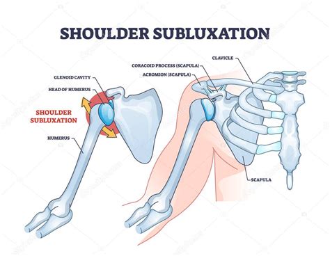 Subluxaci N Del Hombro Como Diagrama De Contorno Del Problema De