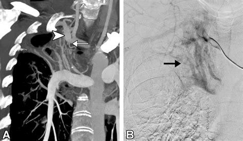 Subclavian Artery Anatomic Review And Imaging Evaluation Of Abnormalities Radiographics