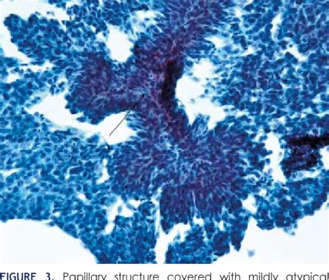 Figure 2 from Urine and bladder washing cytology for detection of urothelial carcinoma: standard ...