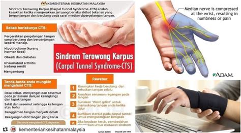 Carpal Tunnel Syndrome Punca Kebas Tangan Senaman And Rawatan