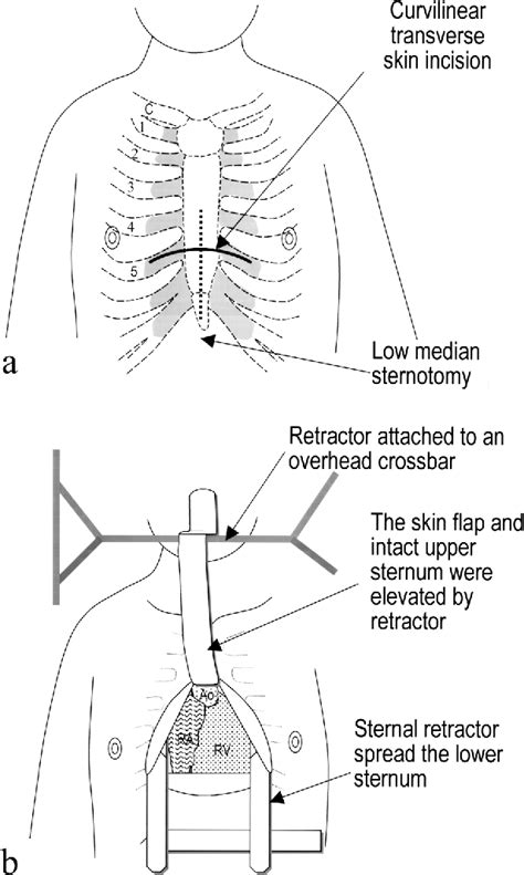 Median Sternotomy