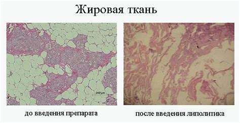 Липолитики. Что это такое, инъекции мезотерапии, уколы для похудения ...