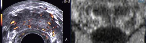 Figure 1 From Targeted MRI TRUS Fusion Guided Biopsy In Men With