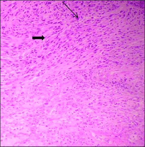 Squamous Cell Carcinoma With Sarcomatoid Features Comprising