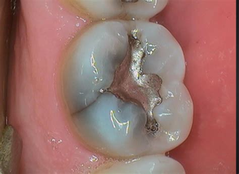 Procedure For Cracked Molar