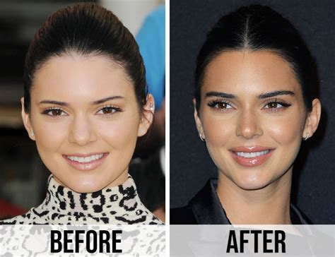 These Before And After Pics Of Kendall Jenner Are INSANE—What Did She ...