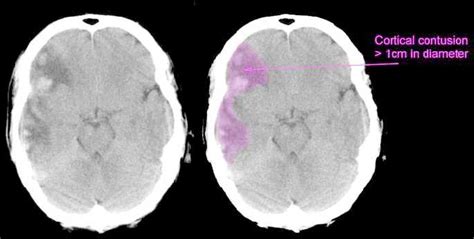 International University: Cerebral Contusion: