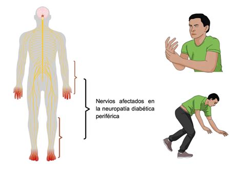 Neuropatía Diabética La Enfermedad Del Calcetín Y Guante