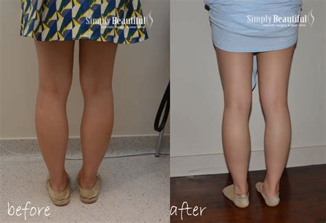 Slim Leg Calf Slimming Dr Peter Kim Cosmetic Laser Clinic