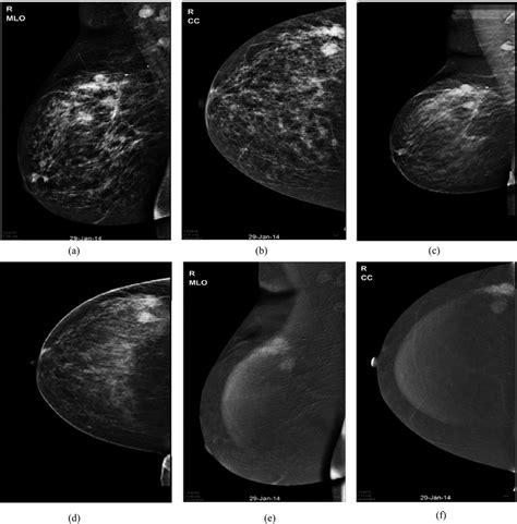 A 59 Year Old Female Patient With Right Breast Masses And Palpable Download Scientific Diagram