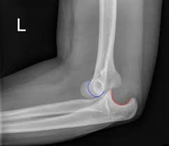 Elbow Dislocation - Physioflow PT | Physical Therapy | Vancouver, WA