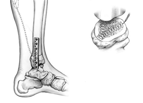 Internal fixation of tibia in conjuction with implanted electromagnetic bone stimulation - Wendy ...