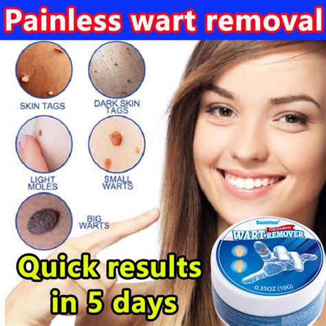 Warts Remover Cream Kulugo Skin Tag Foot Corns Remover Private Genital