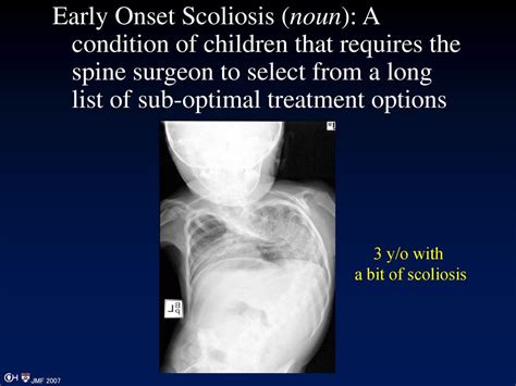 Imaging In Early Onset Scoliosis Ppt Download