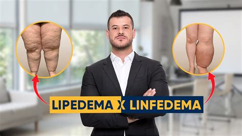 LIPEDEMA E LINFEDEMA qual a diferença Dr Felipe Balem YouTube