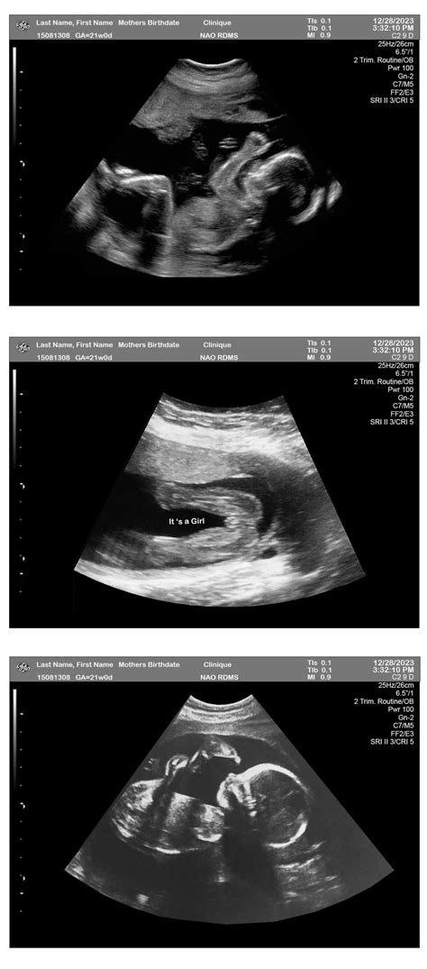 3 Fetuses 21 Weeks Ultrasound Girl Ultrasounds