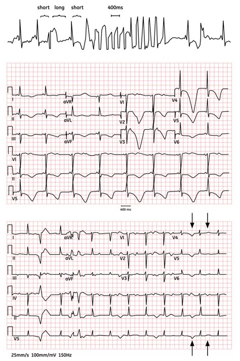 QT Interval Monitoring in Periop and Critical Care | Clinical View