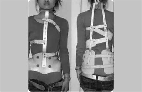 Milwaukee Brace Comparison: Scoliosis Treatment Guide | Treating Scoliosis