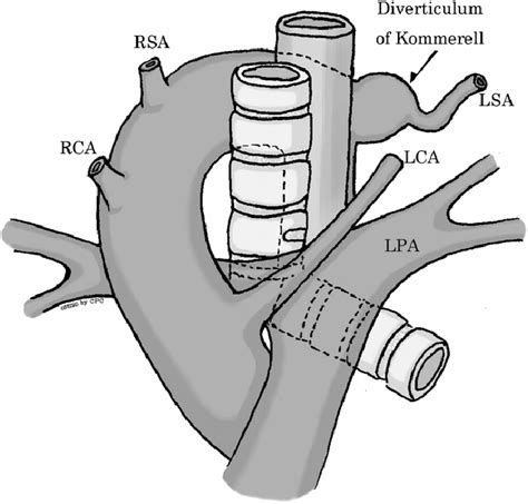 The Anatomy Of The Right Aortic Arch With Aberrant Left Subclavian