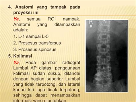 Ppt Kritisi Dan Evaluasi Radiograf Lumbal Dan Lumbosacral Ppt Free