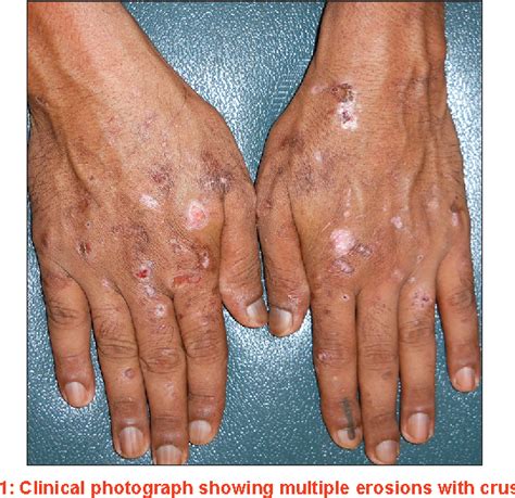 Figure 1 From Porphyria Cutanea Tarda In A Human Immunodeficiency Virus