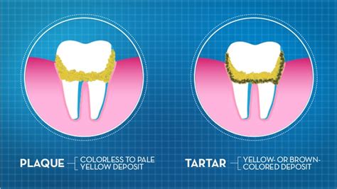 What To Know About Plaque And Tartar Bracken Barrett