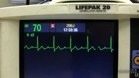 Ekg Training Watching And Interpreting The Defibrillator Monitor Monitor Ekg Castu