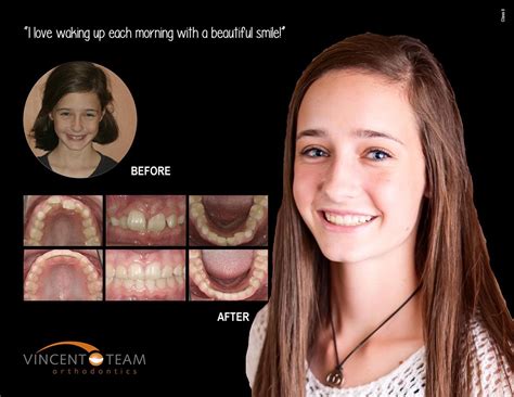 Smiles Gallery Vincent Team Orthodontics