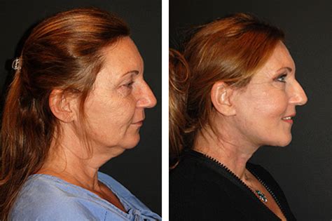 Deep Plane Facelift Deep Plane Facelifting Dr Andrew Jacono