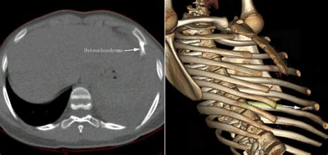 Left Axial Oblique Reconstruction Showing The Inferoposterior Course