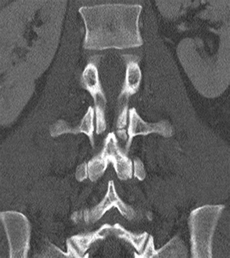 Oppenheimer Ossicle Radiology Case Radshare Net