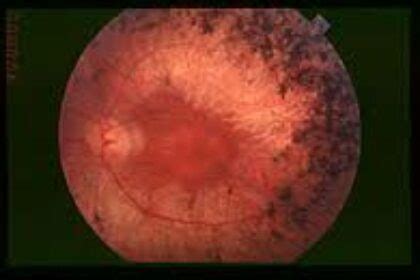 Retinosis Pigmentaria Centro Medico Herrera