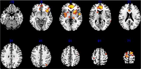 Group Results From Eeg Informed Fmri Using Glm Z Axis Is Indicated In