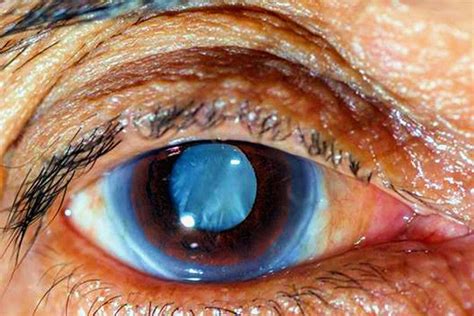 El Glaucoma Causas Y Tratamiento Oftalima Centro Oftalmológico Lima Perú