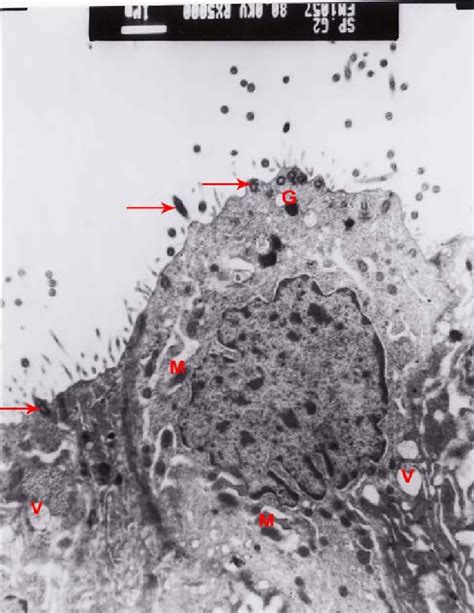 Electron Micrograph Of Human Endometrium Of Rpl Group Showing Ciliated