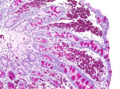 Pathology Outlines Whipple Disease