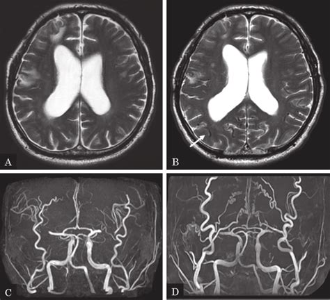 MRI-T2-weighted image 3 months after clipping for left MCA aneurysm... | Download Scientific Diagram