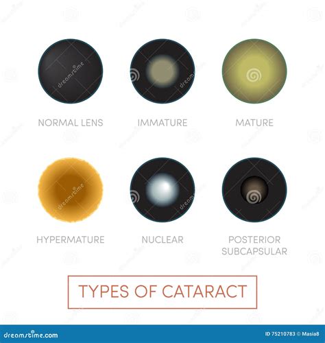 Types of cataract stock illustration. Illustration of healthcare - 75210783