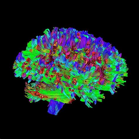 Brain Tumour By Simon Fraser Science Photo Library