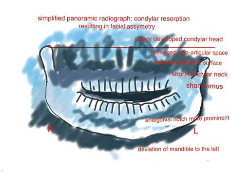 progressive condylar resorption