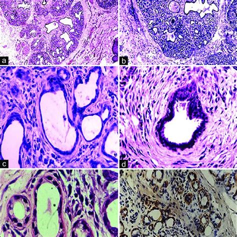 Histopathology Of Pleomorphic Adenoma Of Minor Salivary Gland