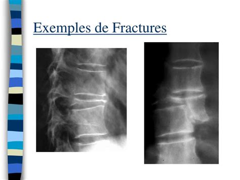 Ppt Les Fractures De C Tes Les Fractures Du Bassin Les Fractures Du