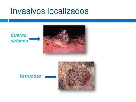 Carcinoma Espinocelular