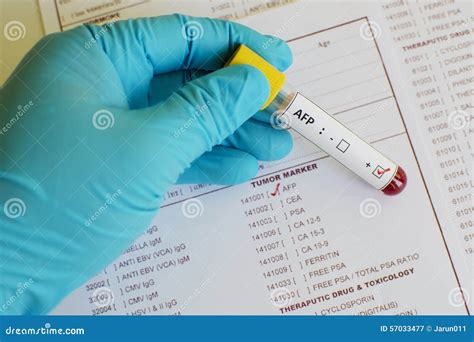 AFP positive stock image. Image of exam, disease, marker - 57033477